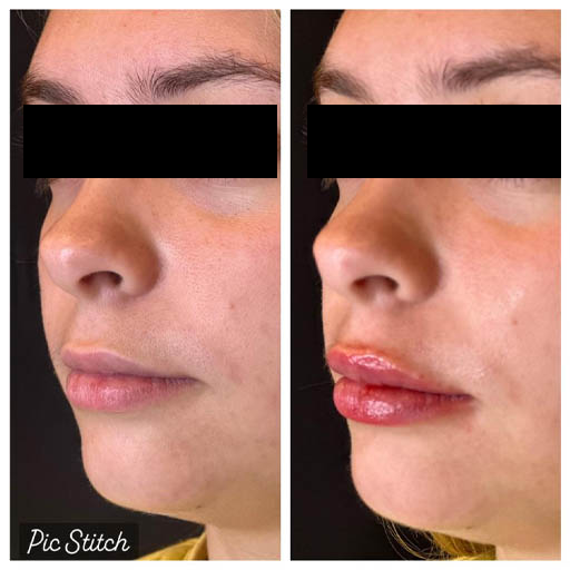 1_0012_LIP-FILLER_Page_09_Image_0001.jpg