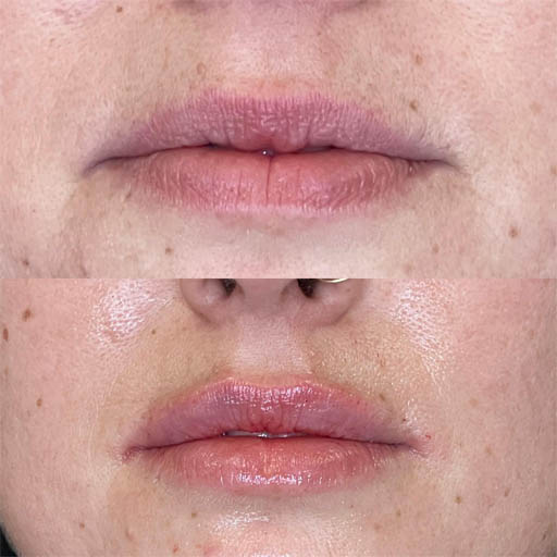 1_0013_LIP FILLER_Page_10_Image_0001.jpg