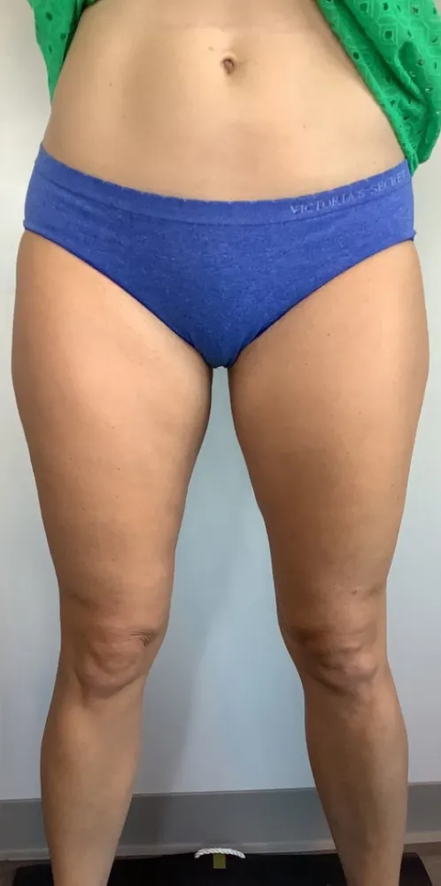coolsculpting_6-6-1000×1000-after