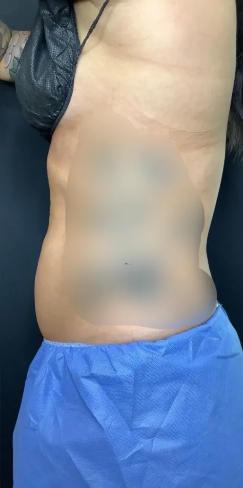 coolsculpting_8-6-1000×1000-after