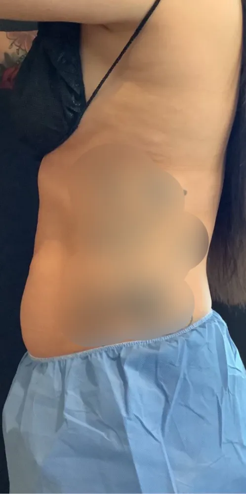 coolsculpting_8-6-1000×1000-before