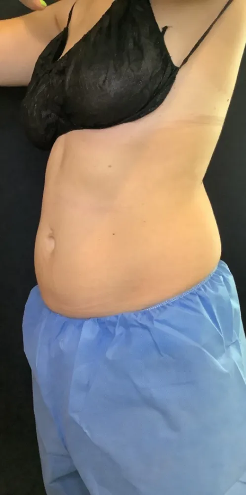 coolsculpting_9-6-1000×1000-before