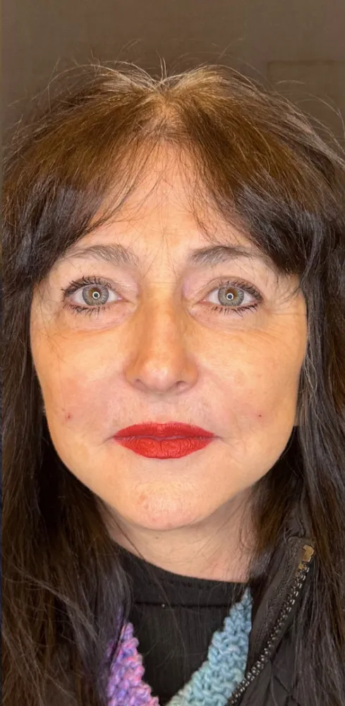 dermal_1-8-1000×1000-after