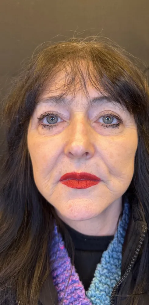 dermal_1-8-1000×1000-before