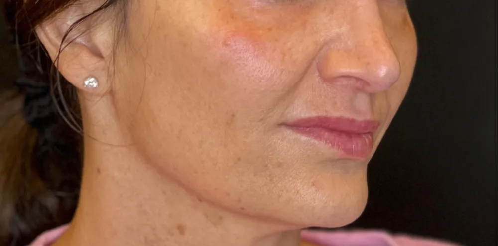 dermal_12-2-1000×1000-before