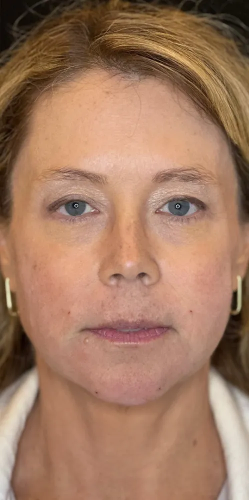 dermal_13-1-1000×1000-after