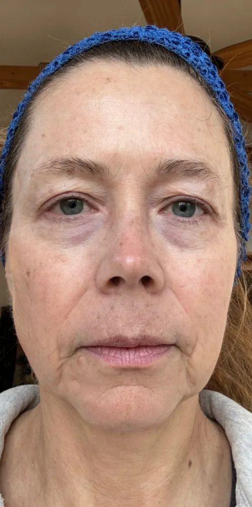 dermal_13-1-1000×1000-before