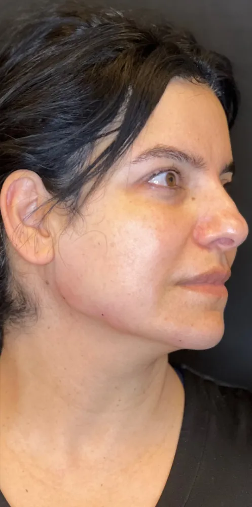 dermal_14-1000×1000-after