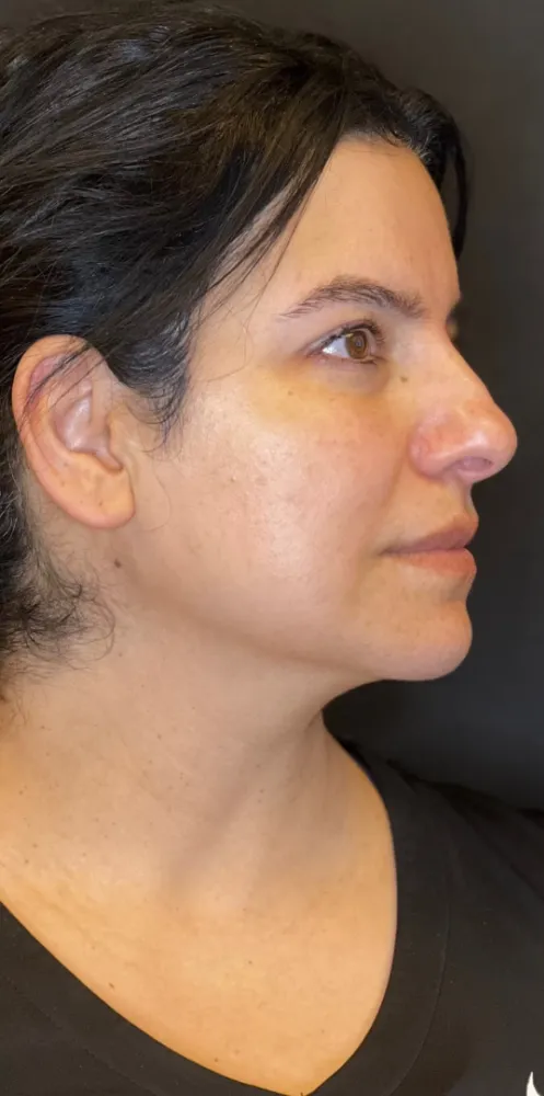 dermal_14-1000×1000-before