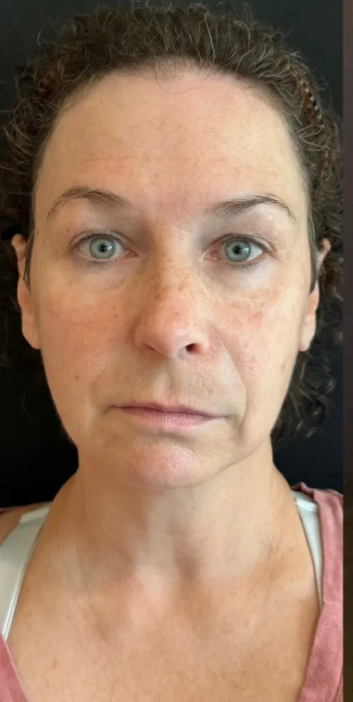 dermal_15-1-1000×1000-before