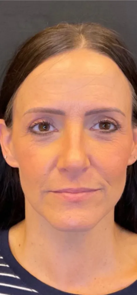 dermal_16-1-1000×1000-before