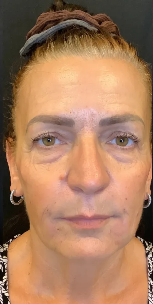 dermal_3-5-1000×1000-after