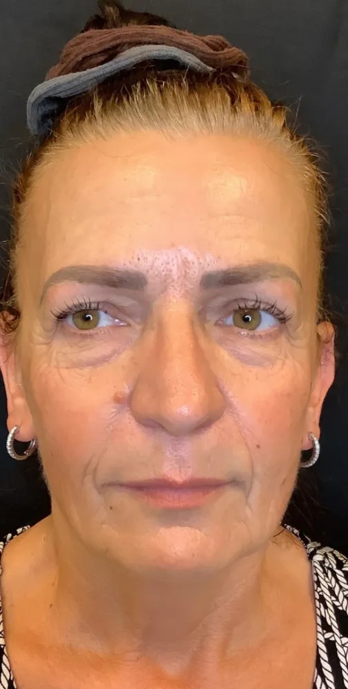 dermal_3-5-1000×1000-before