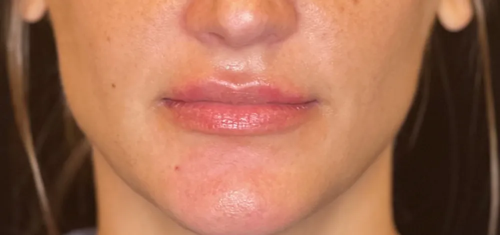 dermal_4-3-1000×1000-after