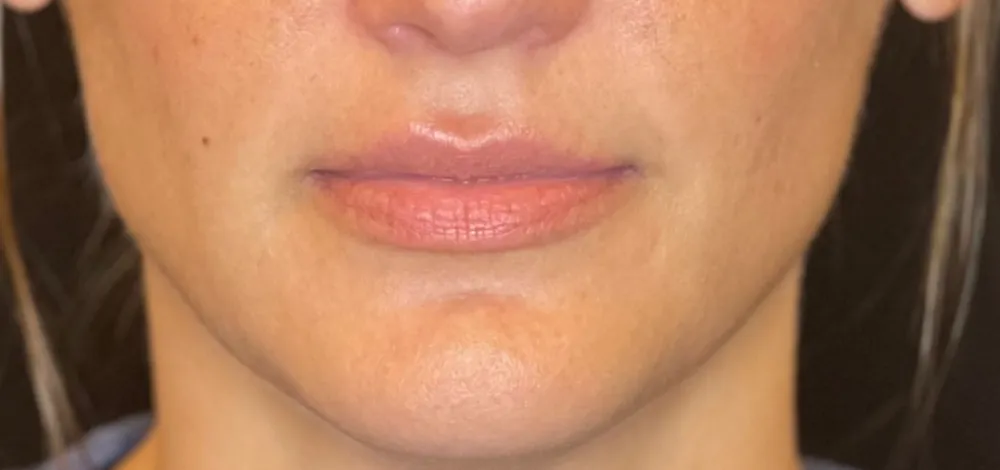 dermal_4-3-1000×1000-before