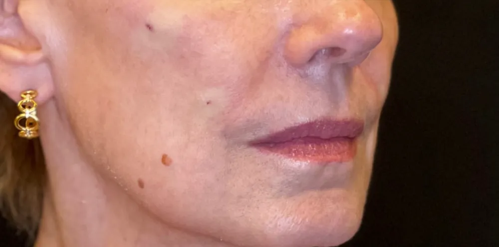 dermal_5-4-1000×1000-after