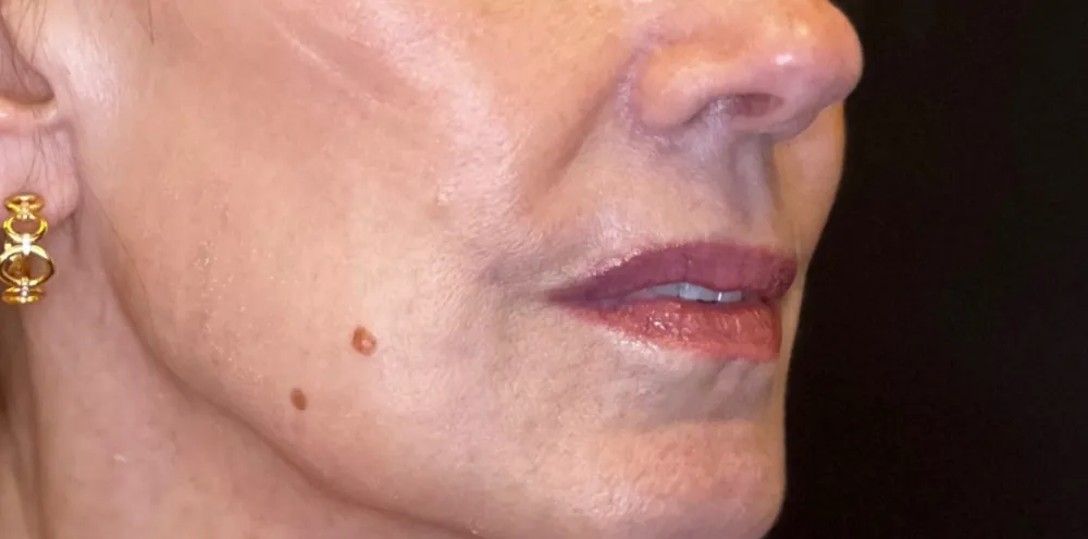 dermal_5-4-1000×1000-before