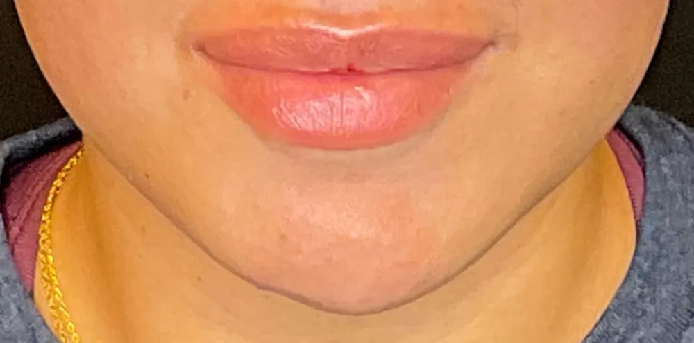 dermal_7-3-1000×1000-before